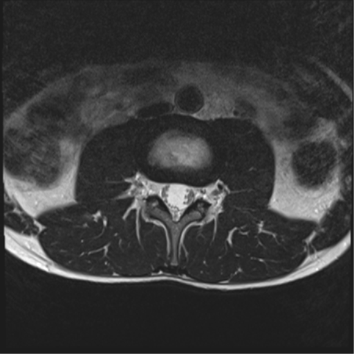 File:Clear cell meningoma - lumbar spine (Radiopaedia 60116-67690 Axial T2 26).png