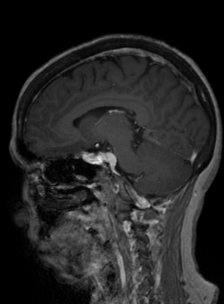 Clival meningioma (Radiopaedia 53278-59248 Sagittal T1 C+ 276).jpg