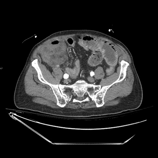 Closed loop obstruction due to adhesive band, resulting in small bowel ischemia and resection (Radiopaedia 83835-99023 B 112).jpg