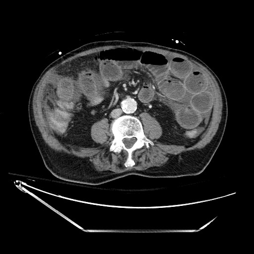 Closed loop obstruction due to adhesive band, resulting in small bowel ischemia and resection (Radiopaedia 83835-99023 D 87).jpg