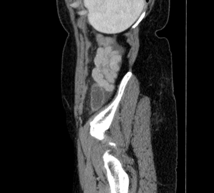 Closed loop small bowel obstruction (Radiopaedia 71211-81508 C 153).jpg