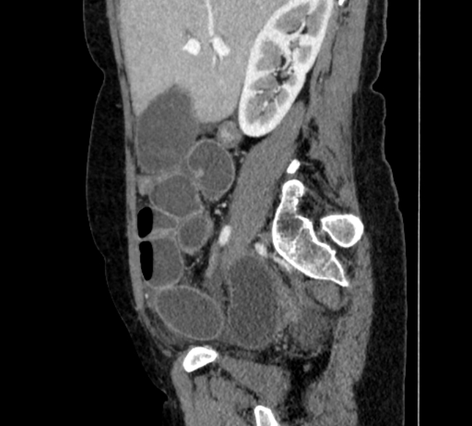 Closed loop small bowel obstruction (Radiopaedia 71211-81508 C 39).jpg