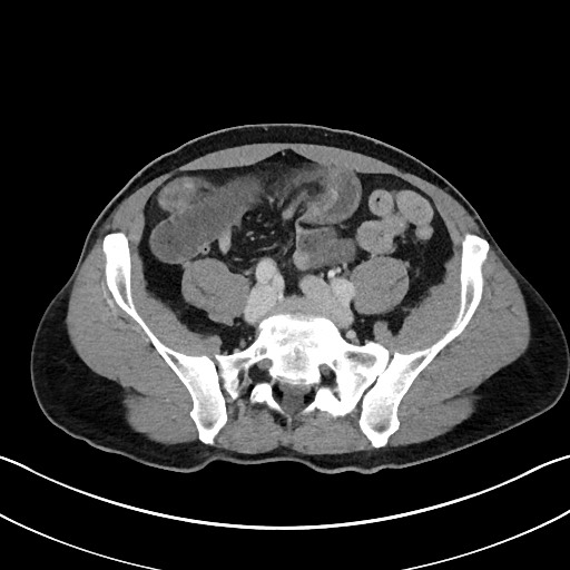 Closed loop small bowel obstruction - internal hernia (Radiopaedia 57806-64778 B 89).jpg