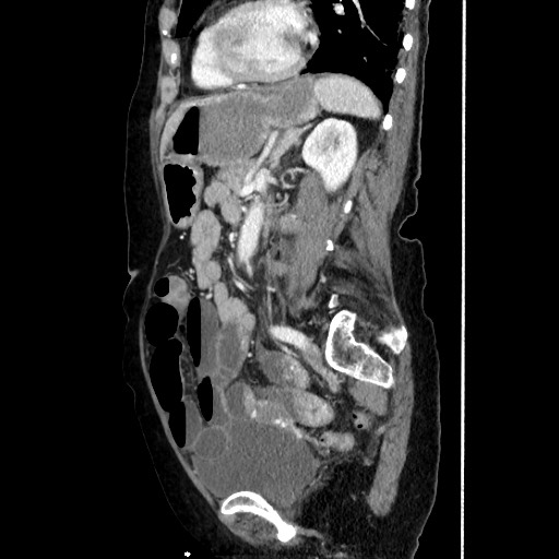 Closed loop small bowel obstruction due to adhesive band, with intramural hemorrhage and ischemia (Radiopaedia 83831-99017 D 121).jpg