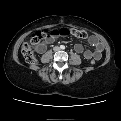 Closed loop small bowel obstruction due to adhesive bands - early and late images (Radiopaedia 83830-99015 A 96).jpg