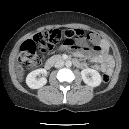 File:Closed loop small bowel obstruction due to trans-omental herniation (Radiopaedia 35593-37109 A 40).jpg