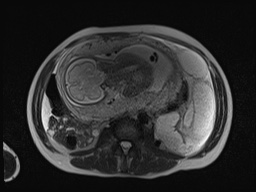 File:Closed loop small bowel obstruction in pregnancy (MRI) (Radiopaedia 87637-104031 Axial T2 40).jpg