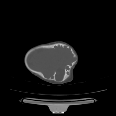 Cloverleaf skull (Radiopaedia 91901-109710 Axial bone window 129).jpg