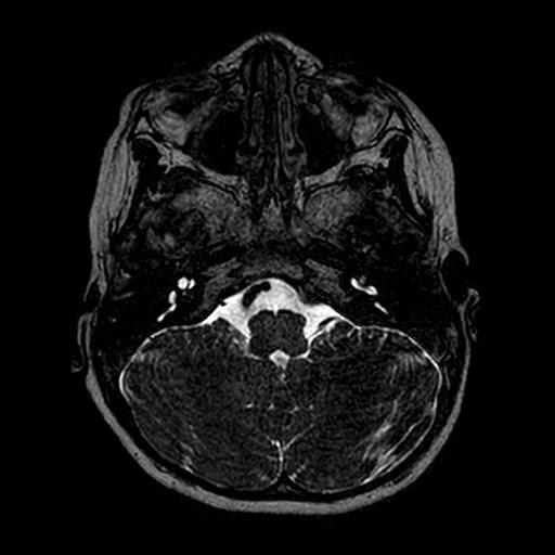 File:Cochlear nerve aplasia - unilateral (Radiopaedia 87910-104413 Axial T2 13).jpg