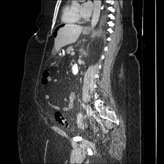 File:Collection due to leak after sleeve gastrectomy (Radiopaedia 55504-61972 C 32).jpg