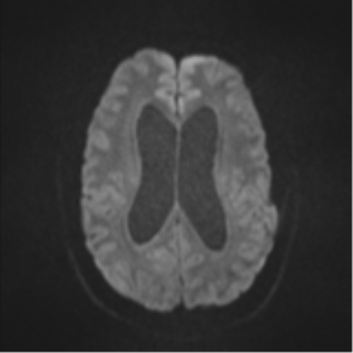 File:Colloid cyst (Radiopaedia 44510-48181 Axial DWI 45).png