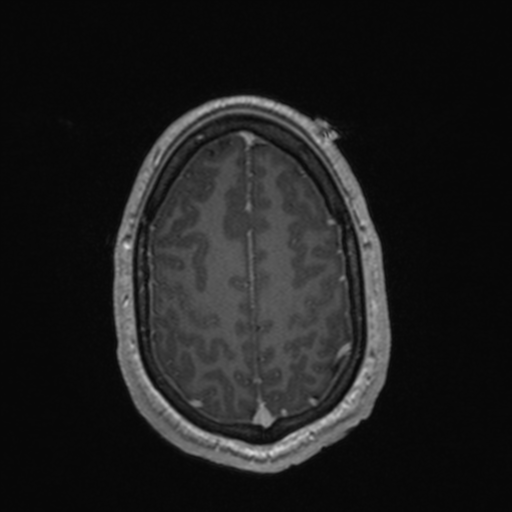 File:Colloid cyst (Radiopaedia 44510-48181 Axial T1 C+ 149).png
