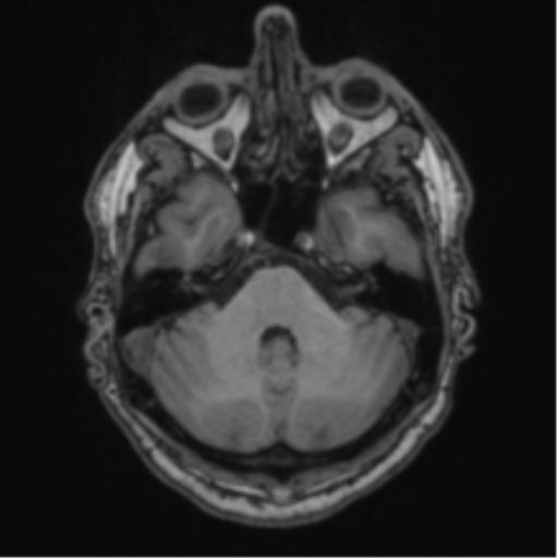 File:Colloid cyst of the third ventricle (Radiopaedia 86571-102662 Axial T1 22).png