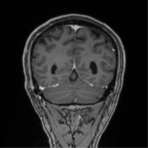 File:Colloid cyst of the third ventricle (Radiopaedia 86571-102662 Coronal T1 C+ 24).png
