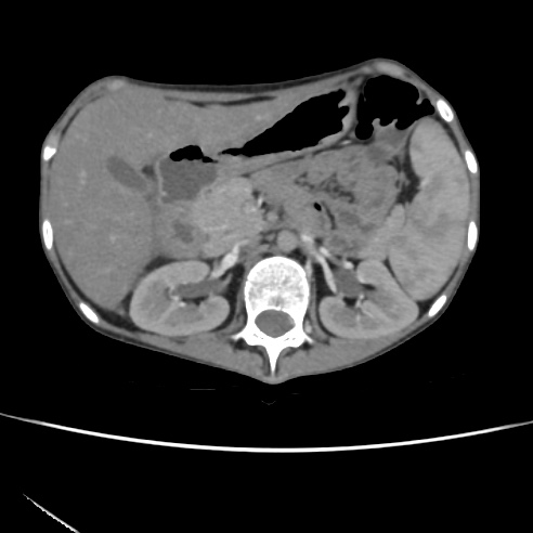 File:Colocolic fistula - Crohn disease (Radiopaedia 57063-63955 A 24).jpg