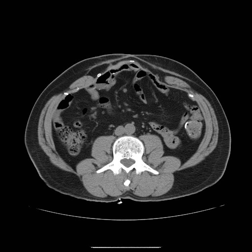 File:Colocutaneous fistula in Crohn's disease (Radiopaedia 29586-30093 D 7).jpg