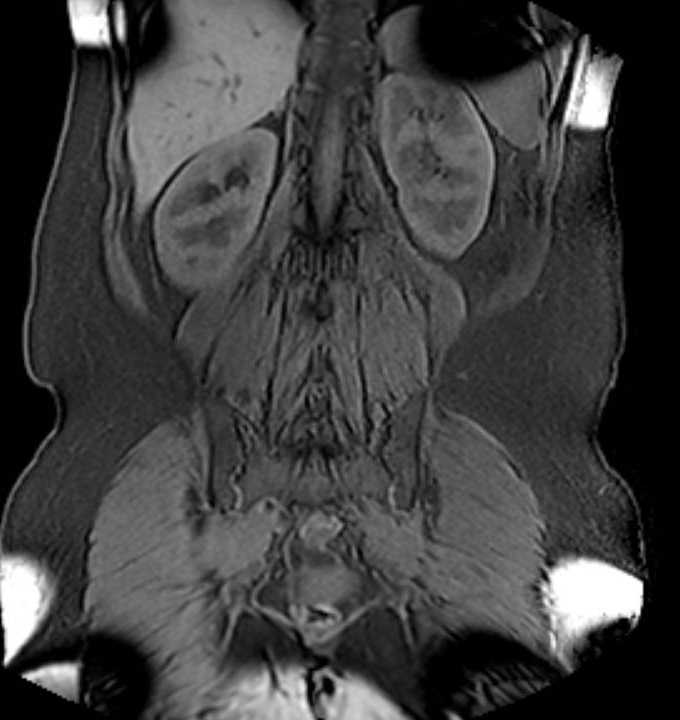Colon adenocarcinoma with Krukenberg tumors, advanced pregnancy (Radiopaedia 67279-76645 E 74).jpg