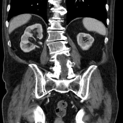 File:Colon cancer with duodenal invasion (Radiopaedia 16278-15958 B 44).jpg
