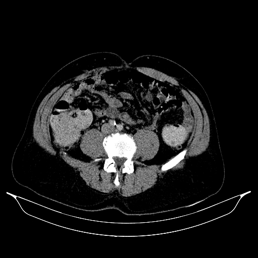 Colonic diverticulosis (Radiopaedia 72222-82744 A 57).jpg