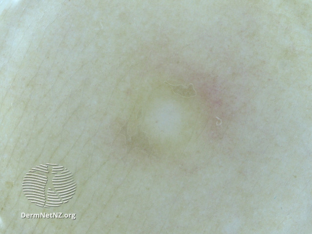 File:Dermoscopy of dermatofibroma (DermNet NZ lesions-dermfib2).jpg