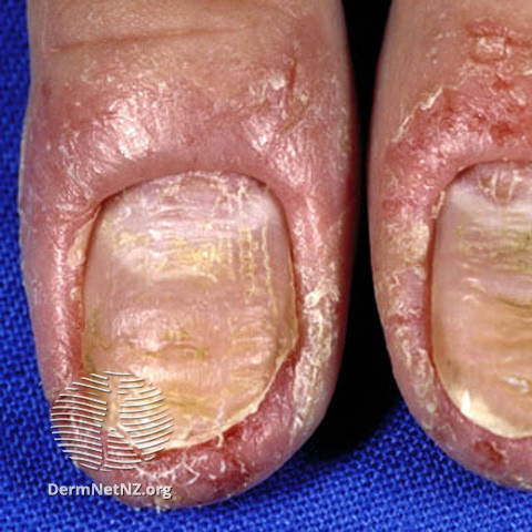 File:Eczema (DermNet NZ fungal-paron6).jpg