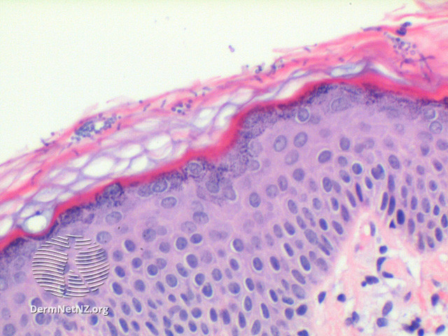 File:Figure 3 (DermNet NZ pathology-t-PVFigure3).jpg