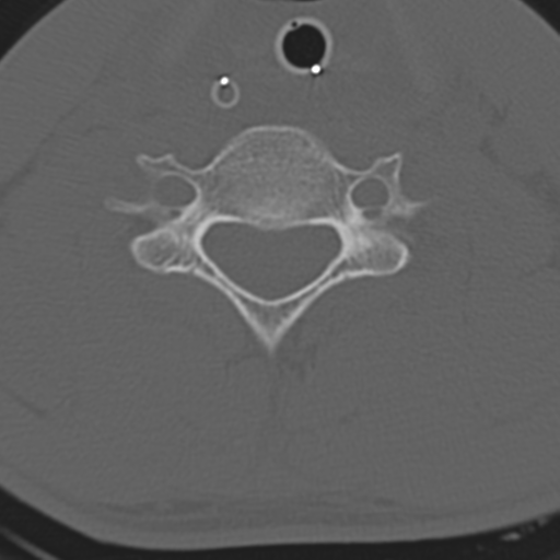 File:Multitrauma with diffuse axonal injury, temporal bone fractures and traumatic caroticocavernous fistula (Radiopaedia 37242-39035 Axial 178).png