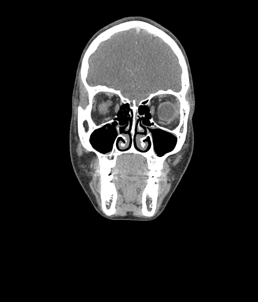 File:Nasal pyogenic granuloma (lobular capillary hemangioma) (Radiopaedia 85536-101244 D 52).jpg