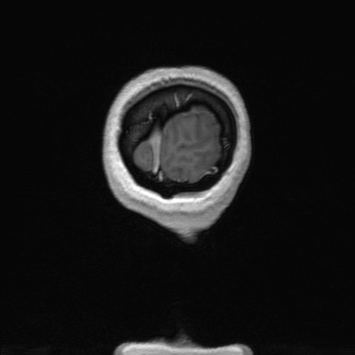 Nasopharyngeal carcinoma (T1 N3a) with complete response (Radiopaedia 61357-69619 Coronal 3D volume 186).jpg