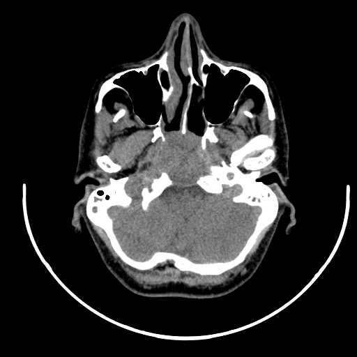 File:Nasopharyngeal carcinoma - infiltrating the clivus (Radiopaedia 62583-70875 Axial non-contrast 13).jpg