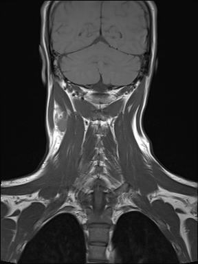 File:Nasopharyngeal carcinoma with perineural spread (Radiopaedia 55030-61380 Coronal T1 20).jpg