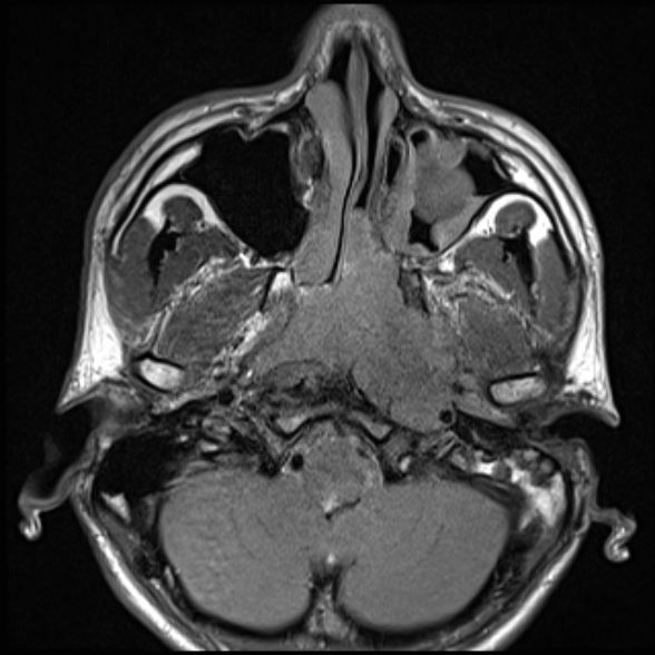 Nasopharyngeal carcinoma with skull base invasion (Radiopaedia 53415-59485 Axial T1 26).jpg