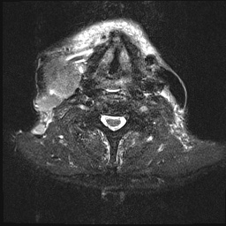 File:Nasopharyngeal carcinoma with skull base invasion (Radiopaedia 59258-66600 Axial T2 fat sat 10).jpg