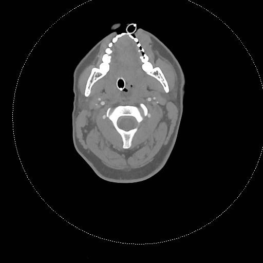 Neck CT angiogram (intraosseous vascular access) (Radiopaedia 55481-61945 B 218).jpg