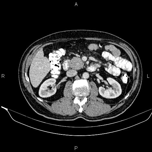 Necrotizing pancreatitis (Radiopaedia 87796-104249 A 24).jpg