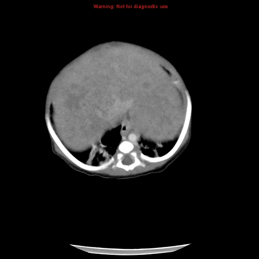 File:Neonatal neuroblastoma (Radiopaedia 9564-10223 A 14).jpg