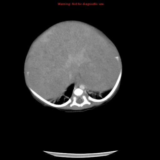 File:Neonatal neuroblastoma (Radiopaedia 9564-10223 A 16).jpg