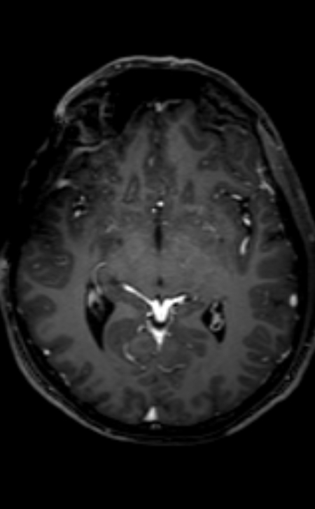 Neuro-Behçet disease (Radiopaedia 90112-107294 Axial T1 C+ 136).jpg