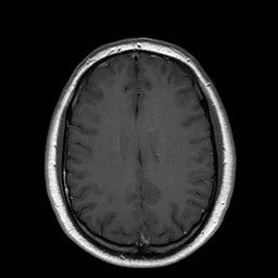 File:Neuro-Behcet's disease (Radiopaedia 21557-21505 Axial T1 C+ 15).jpg