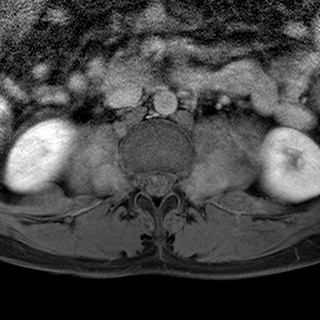 File:Neurofibromatosis type 1- extensive spinal involvement and Christmas tree sign (Radiopaedia 60610-68332 Axial T1 C+ fat sat 71).jpg