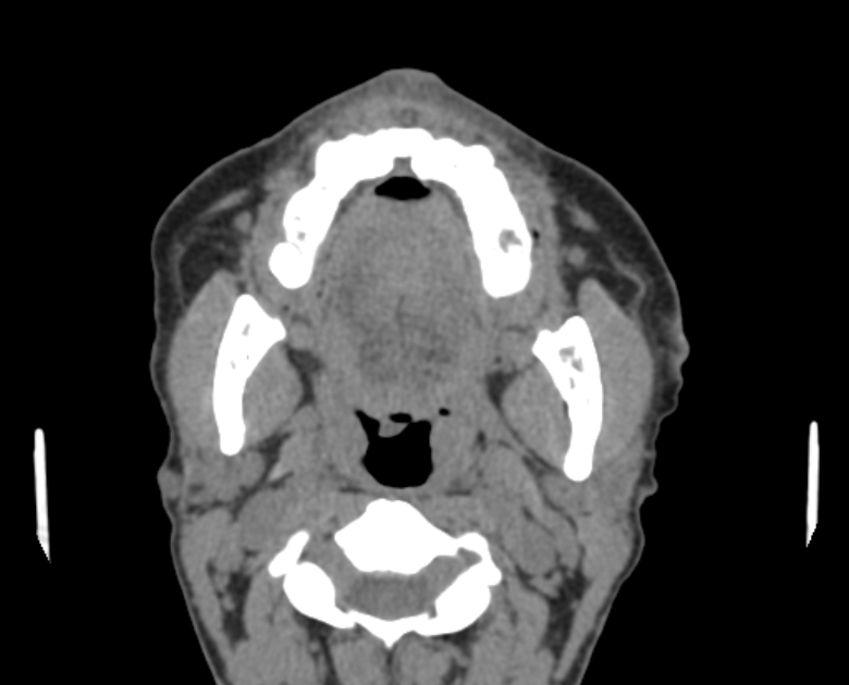 Neurofibromatosis type 1- orbital manifestations (Radiopaedia 49391-54511 Axial non-contrast 1).jpg