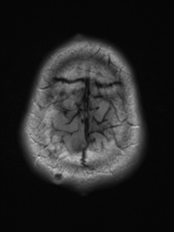 File:Neurofibromatosis type 2 (Radiopaedia 44936-48838 Axial FLAIR 22).png