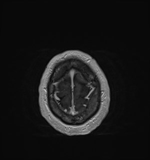 Neurofibromatosis type 2 (Radiopaedia 79097-92049 Axial T1 C+ 178).jpg