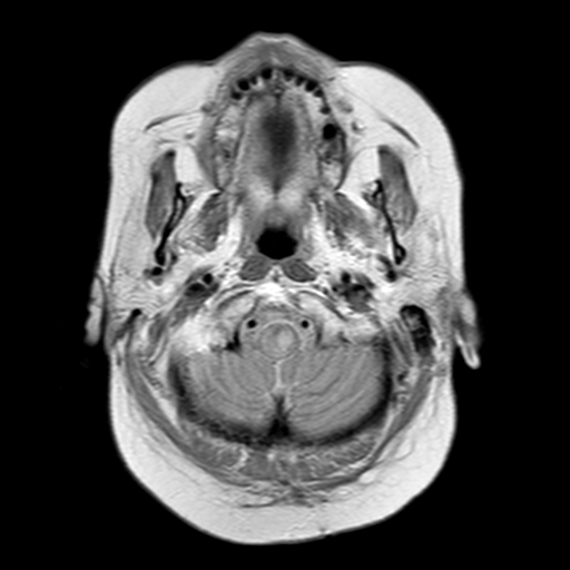 File:Neurofibromatosis type 2 (Radiopaedia 8713-9518 Axial Gradient Echo 23).jpg