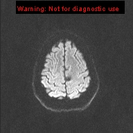 File:Neuroglial cyst (Radiopaedia 10713-11184 Axial DWI 27).jpg