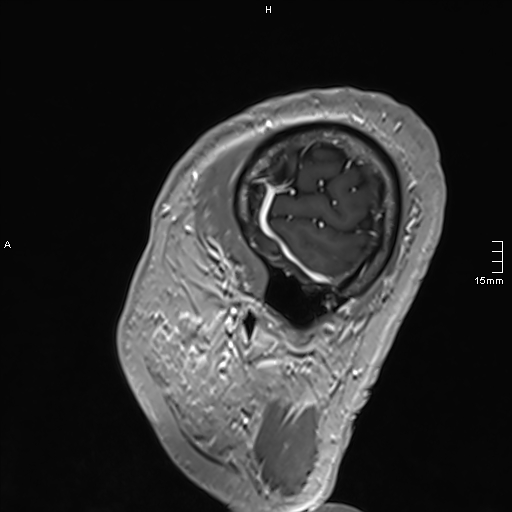 Neurosarcoidosis - involvement of the mesial temporal lobes (Radiopaedia 67429-76820 Sagittal T1 C+ 153).jpg