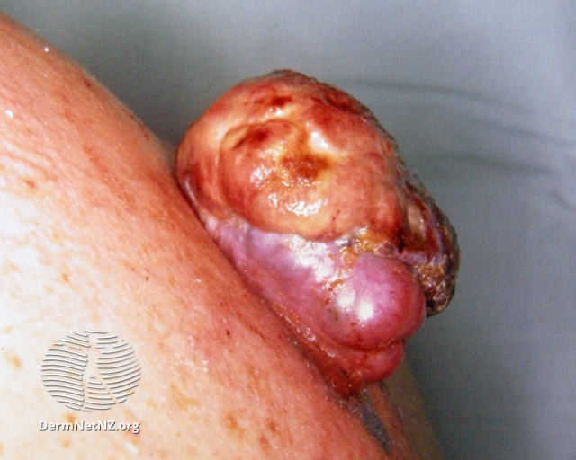 File:Nodular melanoma (DermNet NZ mel3).jpg