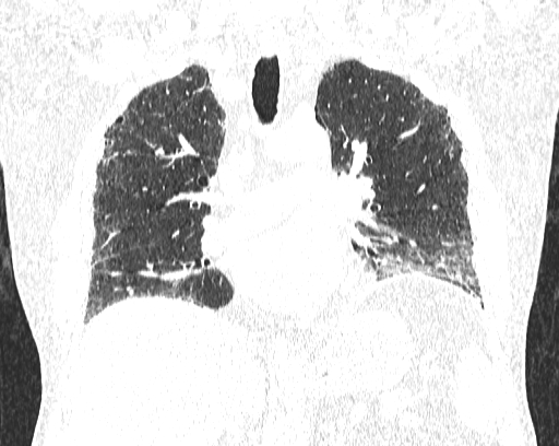 Non-specific interstitial pneumonia (NSIP) (Radiopaedia 68599-78228 Coronal lung window 47).jpg
