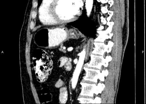 Non-syndromic pancreatic endocrine tumor (Radiopaedia 86958-103178 E 61).jpg