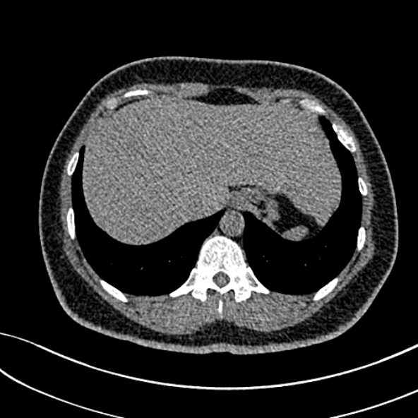 Normal CT chest- adult female (Radiopaedia 52522-58428 Axial non-contrast 111).jpg